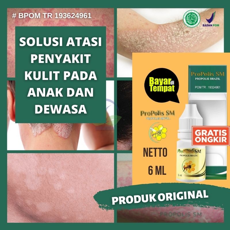 OBAT PANU UNTUK WAJAH TANPA BEKAS, REKOMENDASI OBAT HERBAL PANU DI WAJAH, OBAT PANU AMAN BUAT MUKA, 
