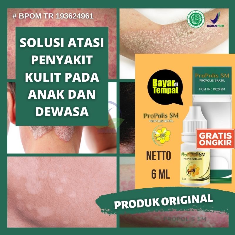 OBAT UNTUK SAKIT EKSIM, OBAT OLES EKSIM KAKI KERING, OBAT EKSIM BASAH DI KAKI, SALEP OLES EKSIM DI J