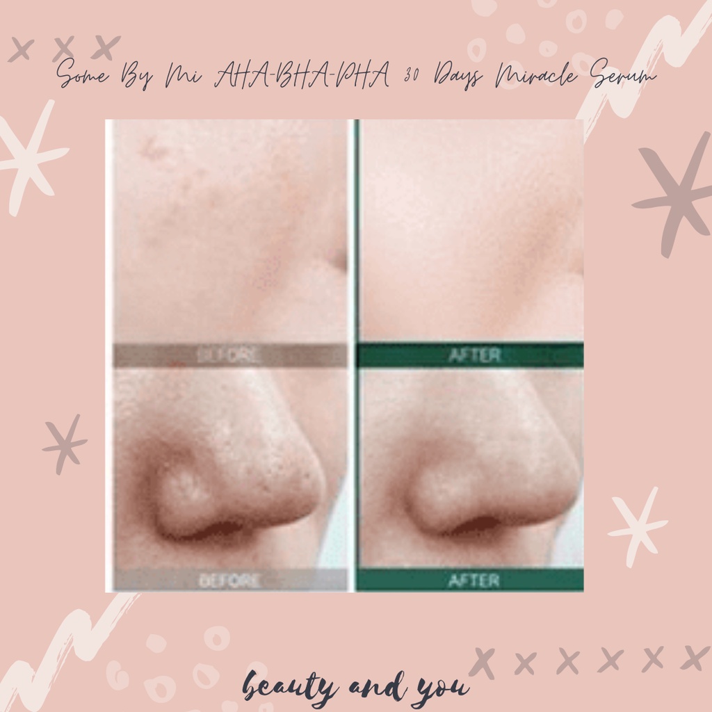 Some By Mi AHA-BHA-PHA 30 Days Miracle Serum (ORIGINAL 100%)