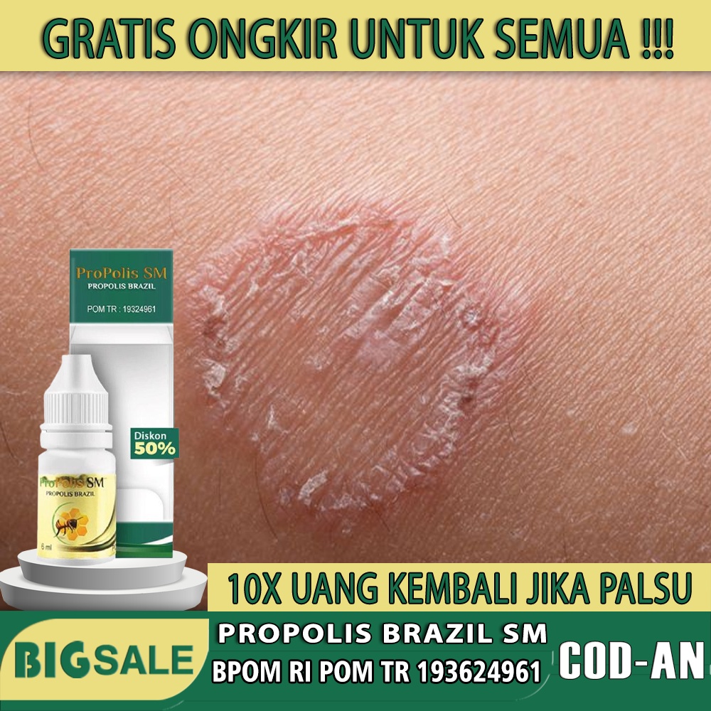 Obat Panu Cair Anak Kadas Kurap Jamur Kulit Hapur Hapuran di Wajah Selangkangan Menahun, obat penghi