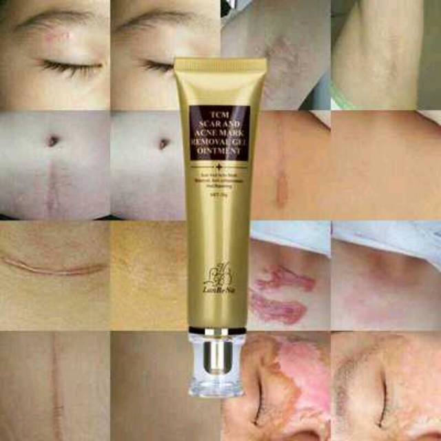 Lanbena TCM Scar and Acne Mark Removal Gel Ointment /penghilang bekas jerawat