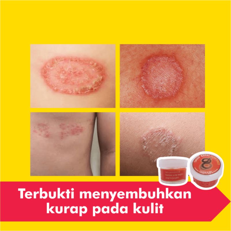 Salep Obat Kurap Kudis Paling Ampuh Gatal Eksim Kutu Air Jamur Kulit Selangkangan Gatel Jerawat Panu-4
