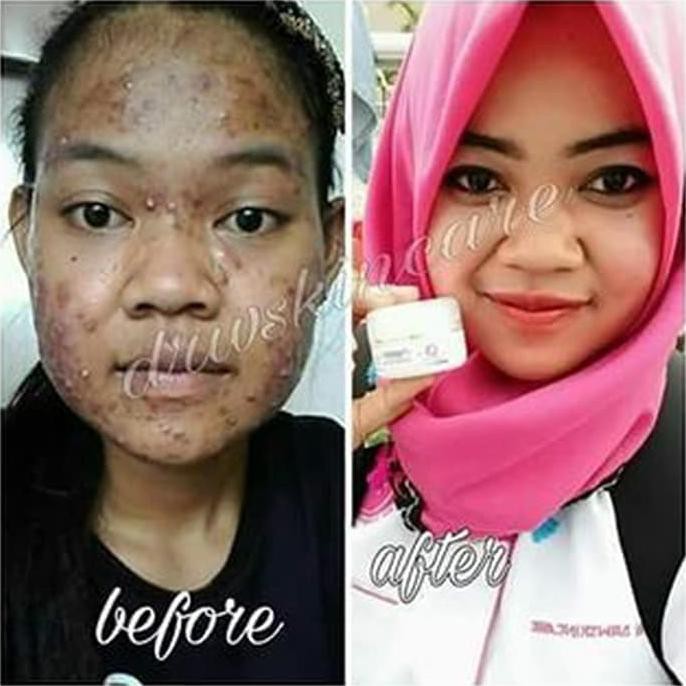 1 Paket Krim Acne Jerawat Drw Skinscare Penghilang Bekas Jerawat Shopee Indonesia