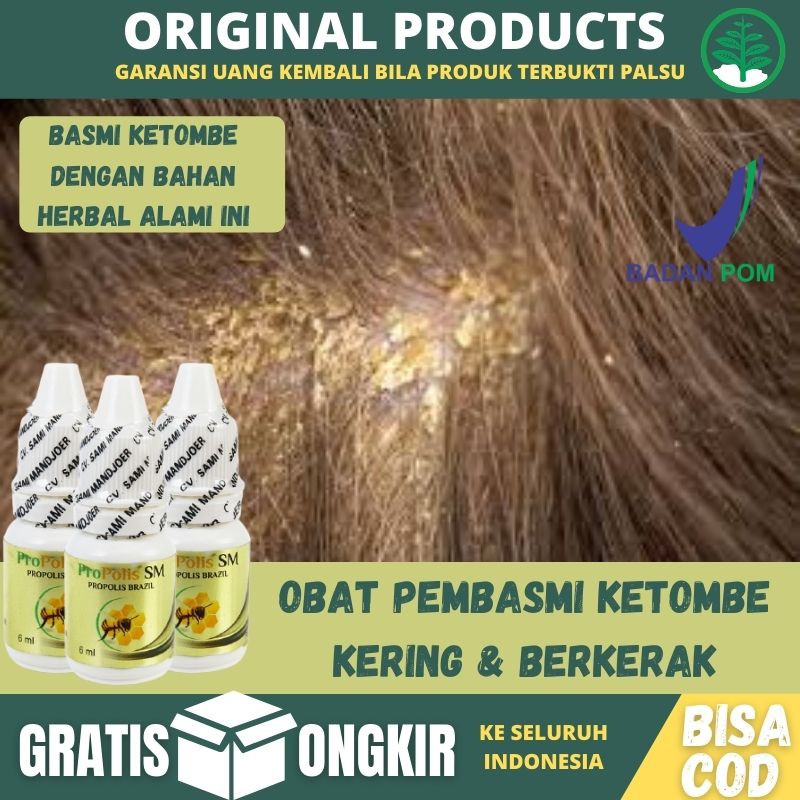 Obat Ketombe Parah Membandel, Obat Gatal2 Akibat Ketombe, Ketombe Berkerak Parah lPropolis SM Alami