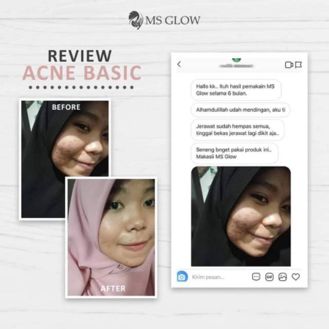 MS GLOW Paket Acne (untuk kuLit wajah berjerawat)