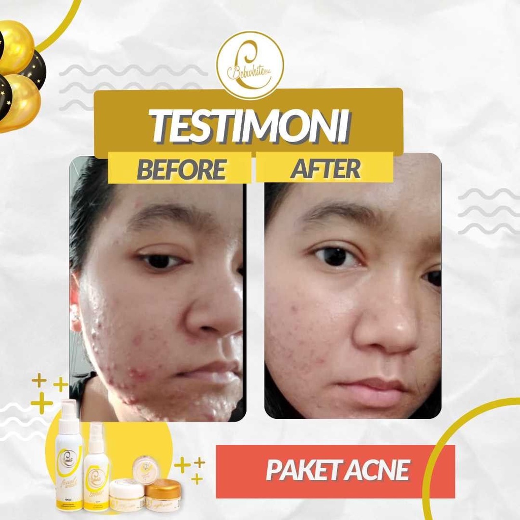 BEBWHITE C BBC BBWHITE GLOW ACNE DAYCREAM TOTOL JERAWAT PERAWATAN WAJAH BERMINYAK