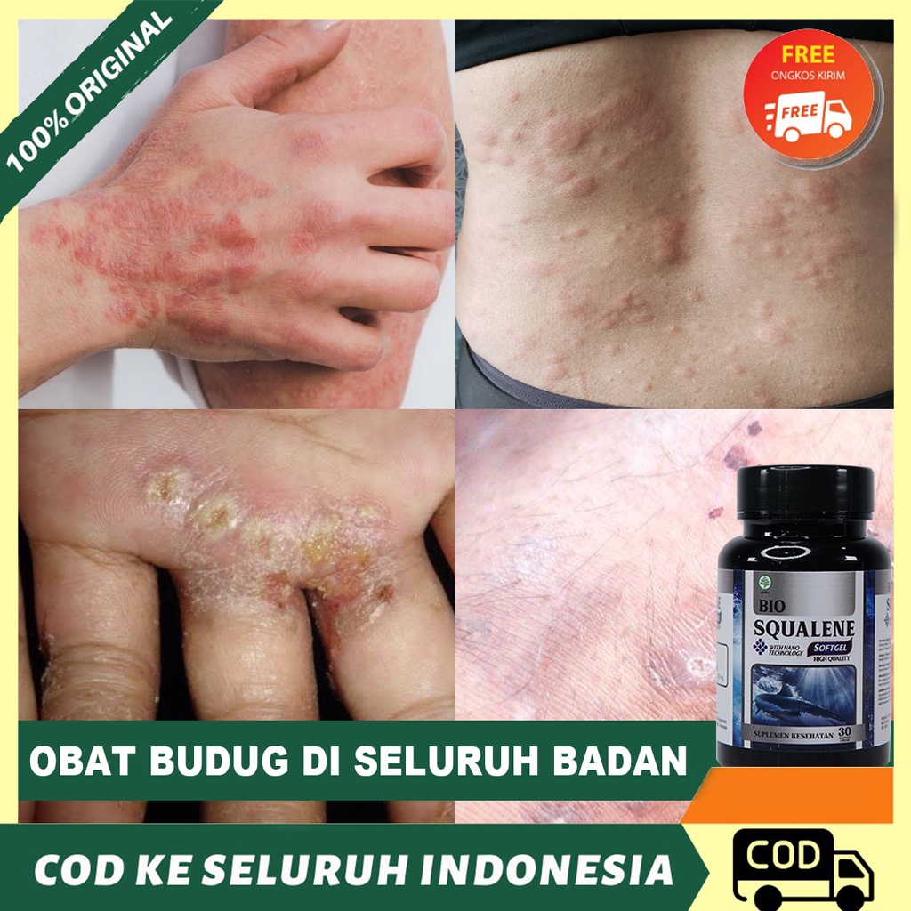 Obat Gatal Seluruh Badan, Gatal Budug Bernanah, Gatal Berdarah - BIO SQUALENE SOFTGEL 100% ASLI