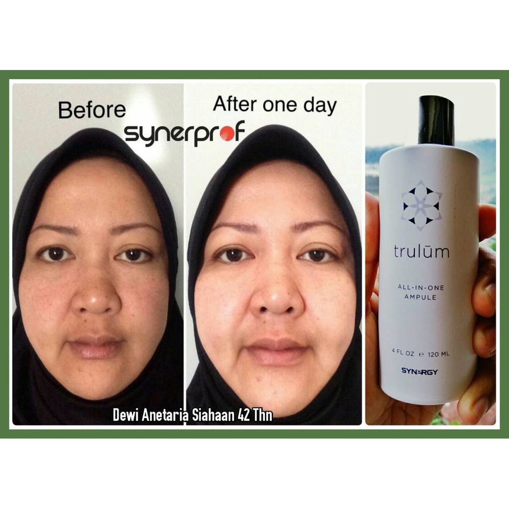 Hilangkan Bekas Jerawat Dengan Trulum | Trulum Solusi Awet Muda