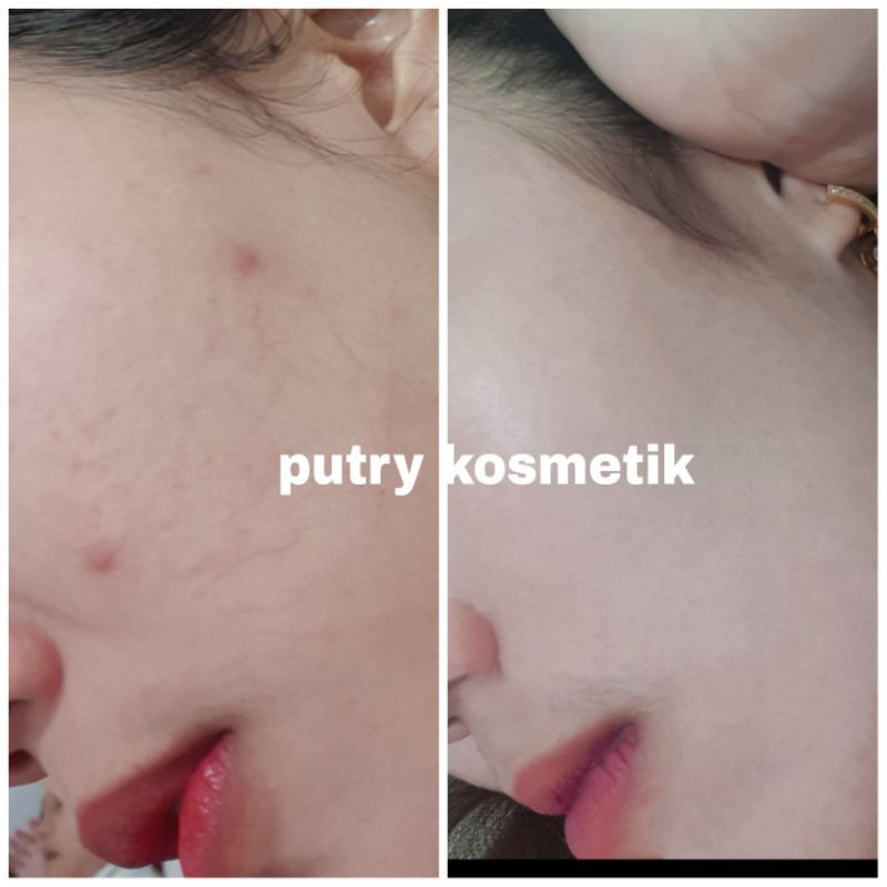 Veins Cream Cream Pembuluh Darah Cream Urat Wajah Cream Sensitif Kulit Tipis Shopee Indonesia