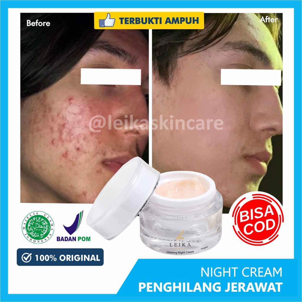 Cream Malam Penghilang Jerawat Batu Pria Bpom Obat Jerawat Batu obat jerawat paling ampuh penghilang