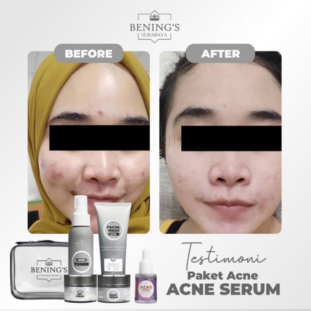 BENING'S PAKET ACNE | MENGATASI MASALAH JERAWAT, BRUNTUSAN &amp; MENCERAHKAN