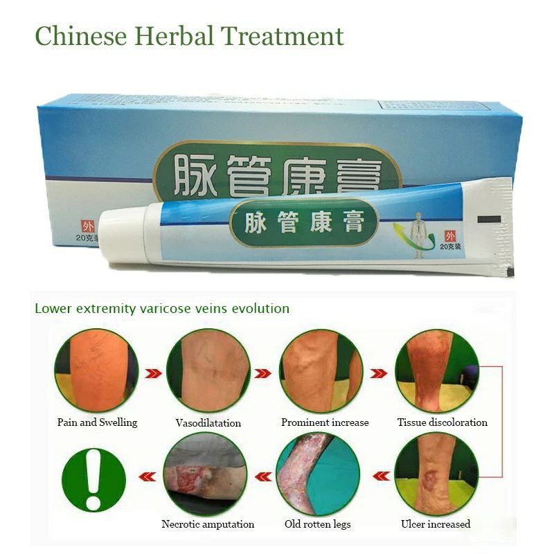 Obat penghilang varises Maiguankanggao krim varicose veins cream salep cina herbal parises Ampuh