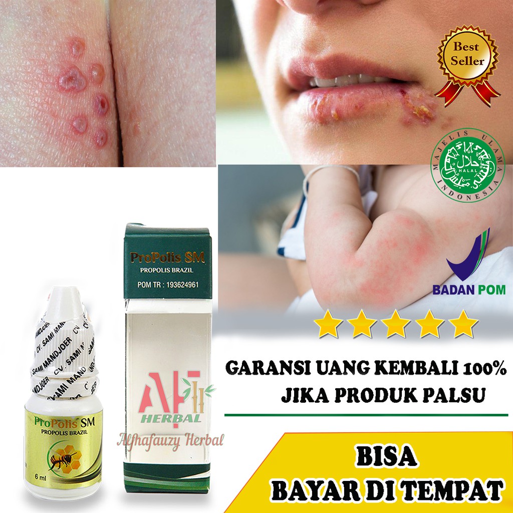 Obat Herpes Di Kaki, Di Kelopak Mata , Di Jidat - Propolis Sm Brazil Original