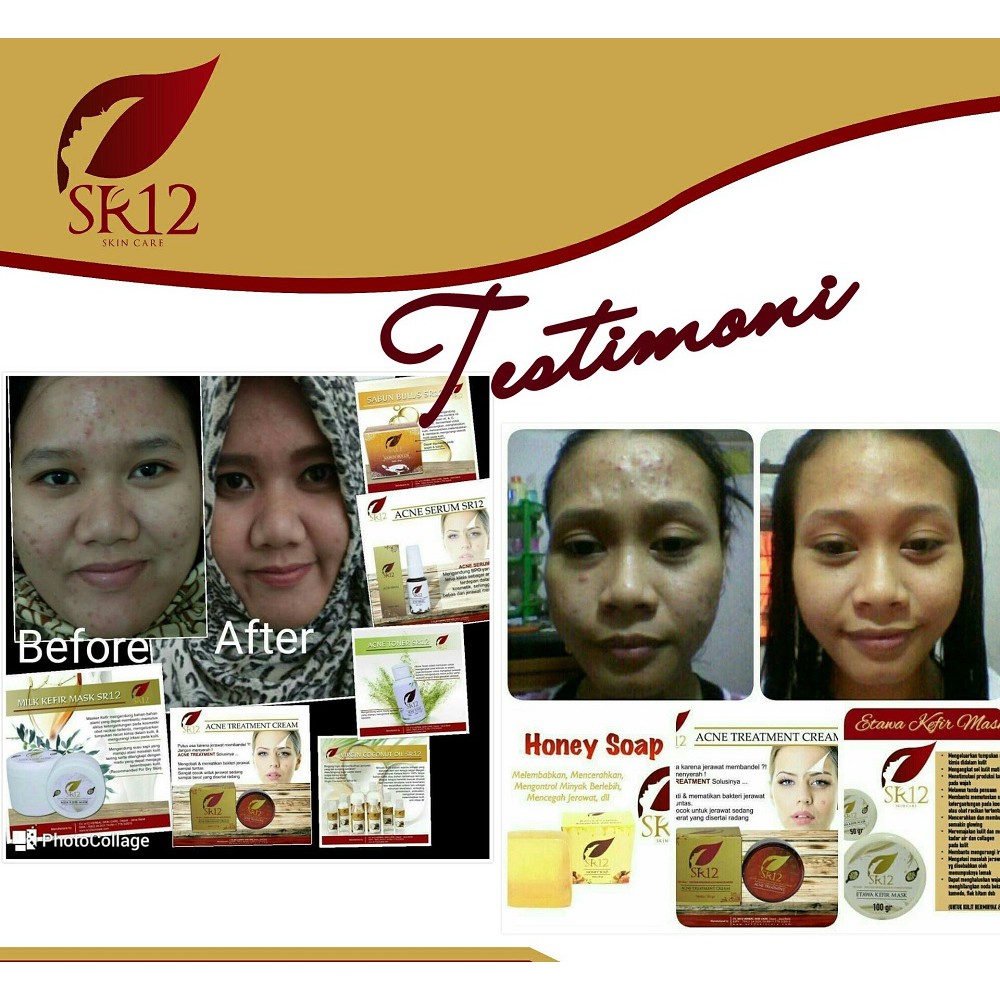 SR12 Acne Treatment Cream - Perawatan Jerawat Untuk Muka Wajah - SR12 Skincare - Skin Care