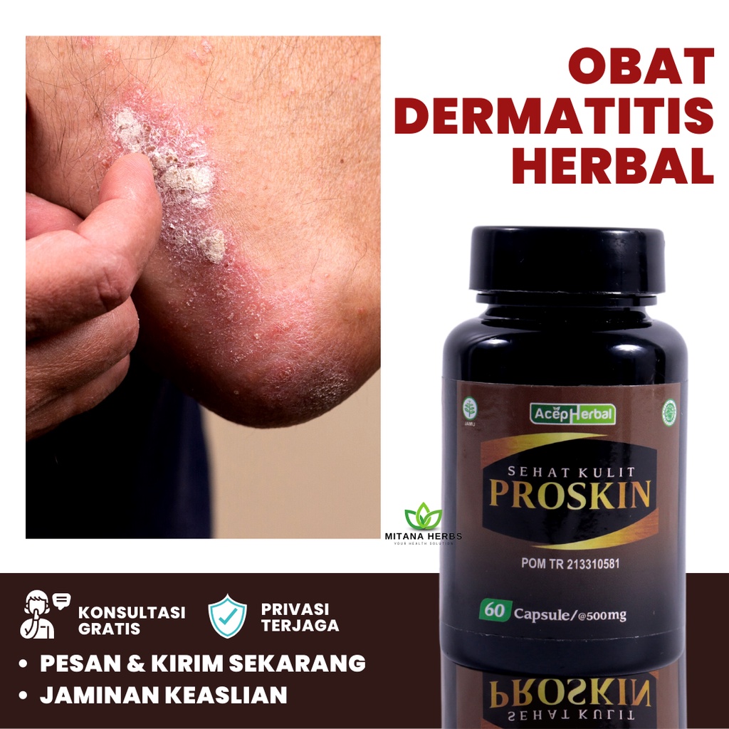 Mitana Herbal - Obat Dermatitis - Dermatitis Seboroik - Dermatitis Atopik - Dermatitis Kontak Alergi
