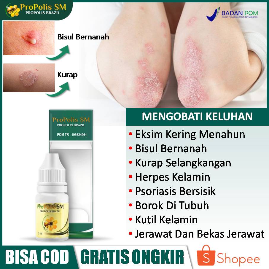 Obat Oles Penyakit Kulit, Eksim Menahun, Kurap Selakangan, Selangkangan Gatal Dan Hitam, Bisul Di Pa