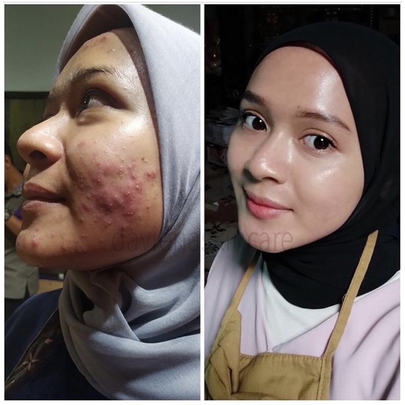 ACNE SERIES DAVIENA SKINCARE