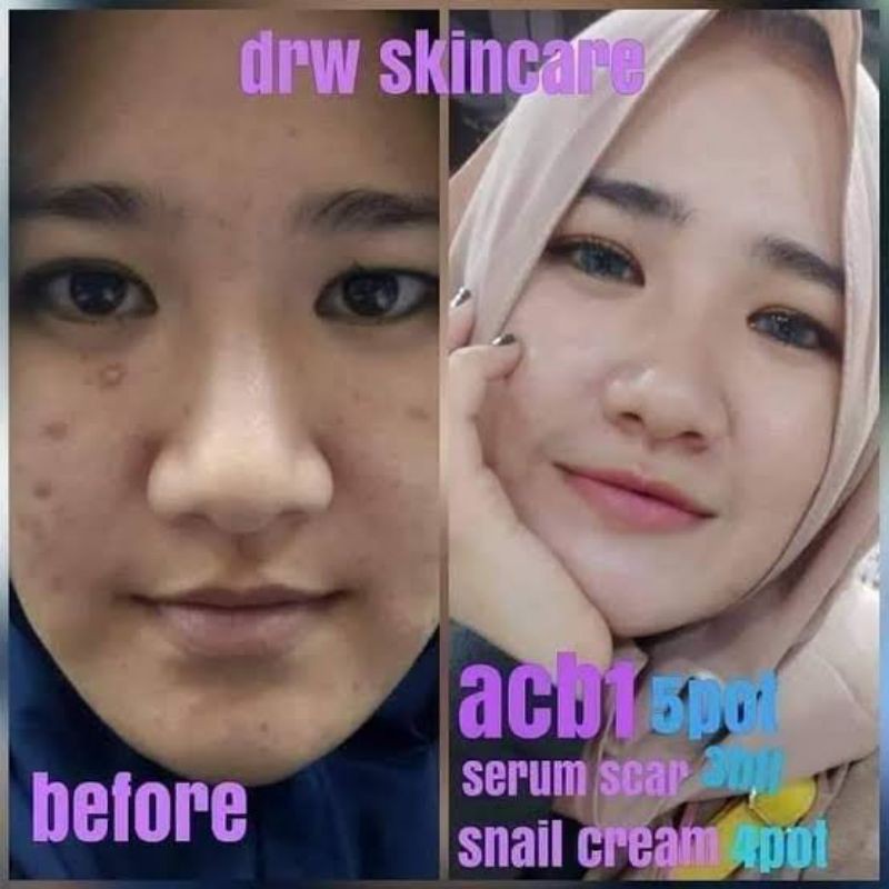 Drw Skincare Original BPOM Paket Acne 1 Penghilang Jerawat Ampuh By dr. Wahyu Triasmara