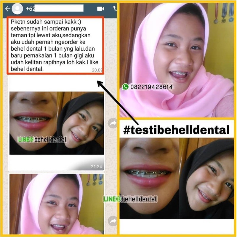 ORIGINAL PAKET BEHEL GIGI PERMANEN BRACKET EURODONTICS EURO METAL WITH HOOK 3 ROTH / BEHEL DENTAL KAWAT Untuk PERAWATAN PERBAIKAN Gigi - Ortho Orthodontic Eurodontic Behelldental