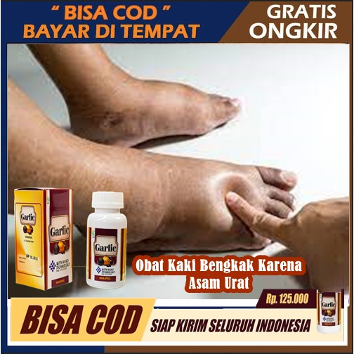 Obat Kaki Bengkak Karena Asam Urat, Obat Bengkak Pada Kaki, Obat Kaki Bengkak & Nyeri, Obat Kaki Ben
