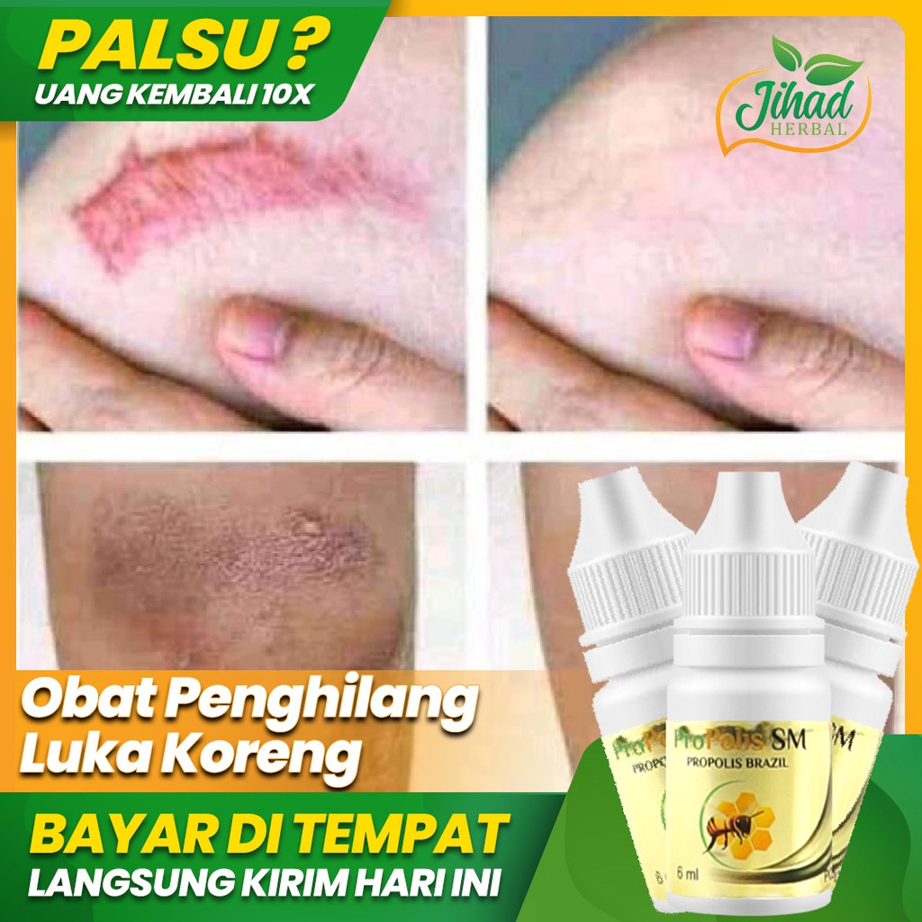 Propolis SM Obat Koreng / Korengan Gatal, Borok, Gatal di Kaki dan Selangkangan Isi 6ml