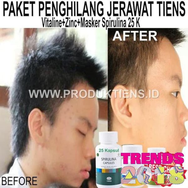 ready Paket Perawatan Kulit Bebas Jerawat Vitaline Zinc  plus  Spirulina Tiens