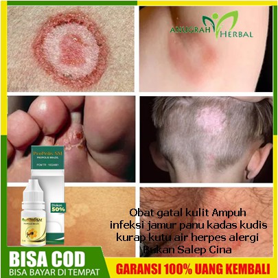 Obat gatal kulit infeksi jamur panu kadas kudis kurap kutu air herpes alergi Bukan Salep Cina