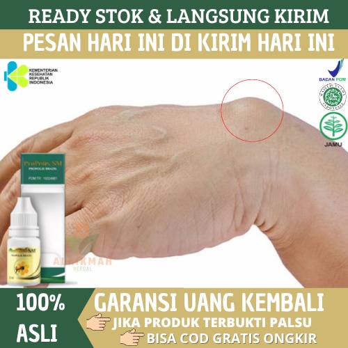 Obat Benjolan di Tangan, Obat Benjolan di Leher, Obat Benjolan di Punggung, Obat Benjolan di Tubuh, 