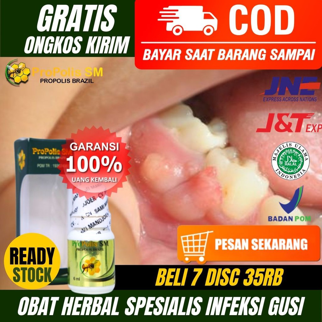 Obat Herbal Infeksi Gusi-Infeksi Gusi Bengkak-Gusi Bernanah-Radang Gusi-Propolis SM