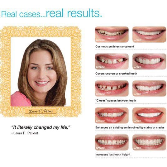 SNAP ON SMILE VENEER GIGI HIGH QUALITY (GIGI ATAS & BAWAH)