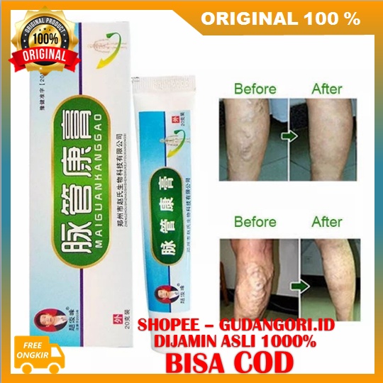 Obat varises Salep penghilang Varises ORIGINAL