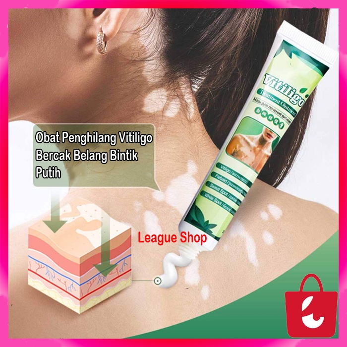 [100% Asli] Obat Penghilang Vitiligo Salep Krim Vitiligo Kulit Bercak Belang Bintik Putih Paling Ampuh 20 gr