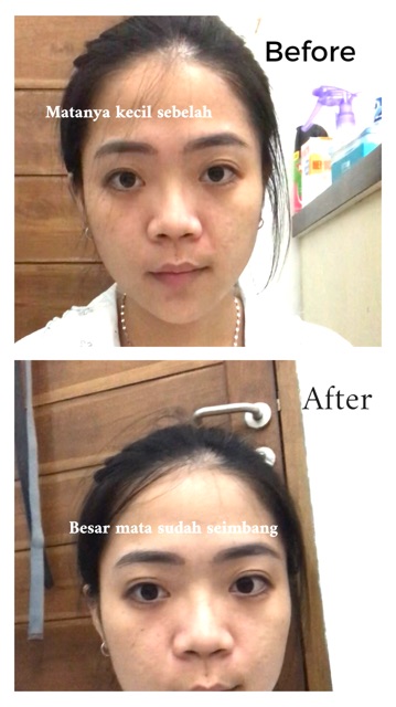 Skot Mata Benang / Fiber Eyelid tape + PAKET FREE GUNTING + FREE Y FORK