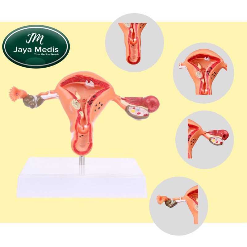 Alat Peraga Anatomi Model Patologis Uterus Ovarium