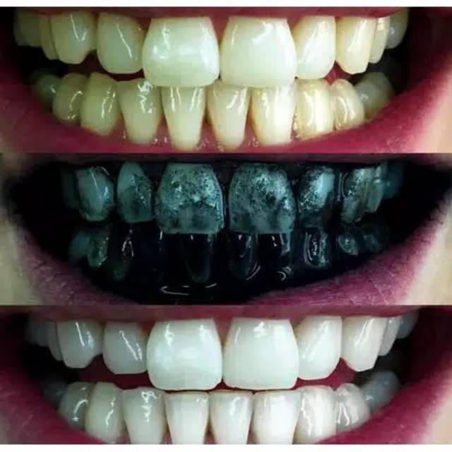 Pemutih Gigi Tercepat Ampuh (ASLI) Alami Natural Aman Bpom Odol Pasta Gigi Teeth Whitening Charcoal