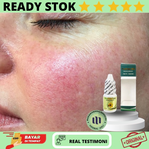 Obat Spider Veins, Obat Penghilang Spider Veins