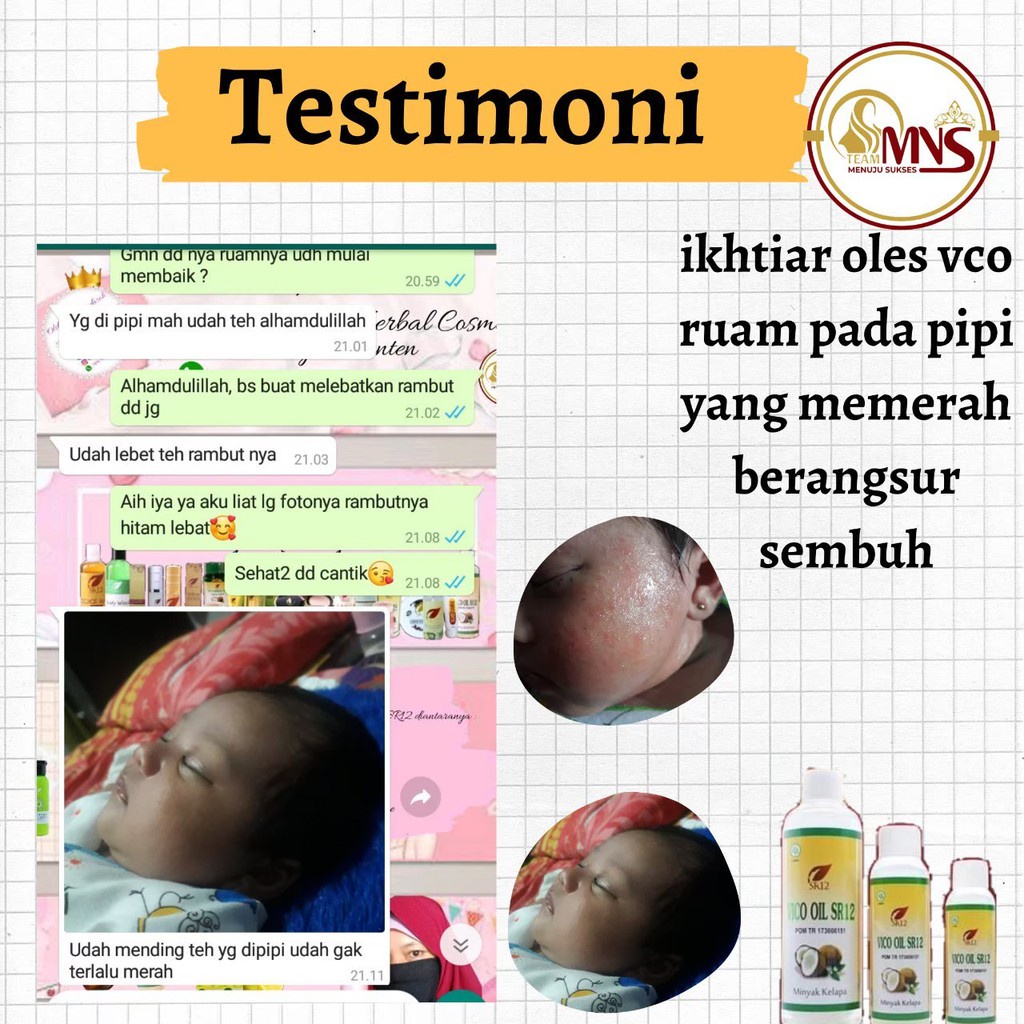 Vco Virgin Coconut Oil Untuk Ruam Popok Bayi Bruntusan Eksim Menghilangkan  Cradle Cap Treatment Baby Lemak Tambahan Mpasi