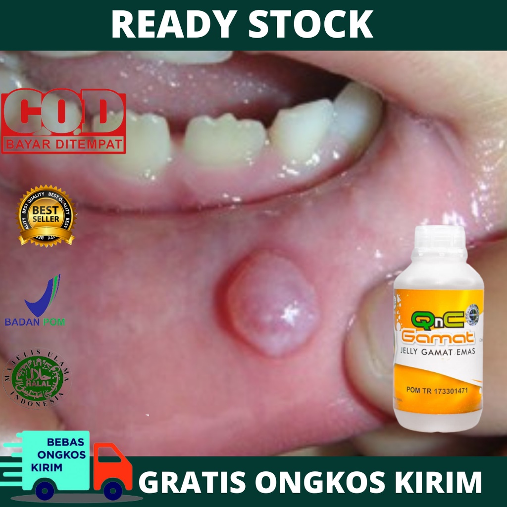 Obat Benjolan Di Bibir, Benjolan di Lidah, Pengempis Benjolan Lidah/Bibir, Kelenjar Air Liur, Penyak