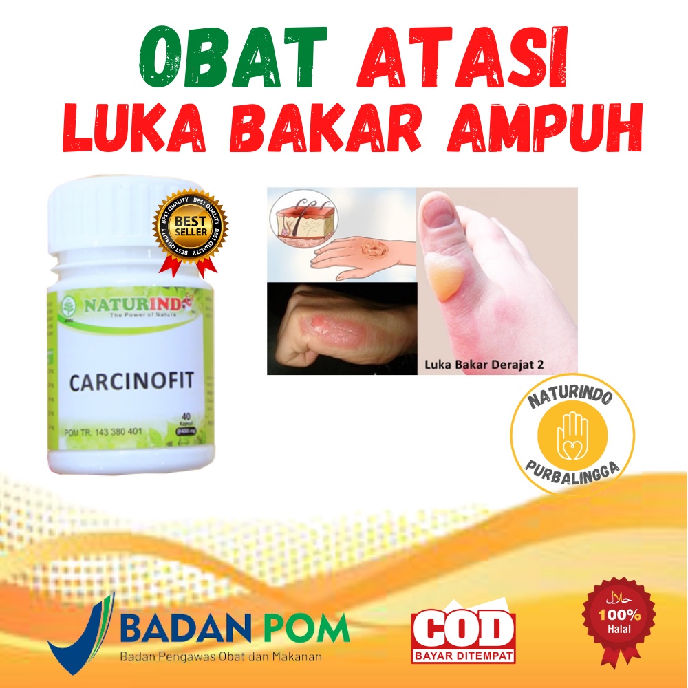 Jual Obat Atasi Luka Bakar Nyeri Yang Masih Bisa Di Tahan Kulit Kering Dan Mengelupas Carcinofit 