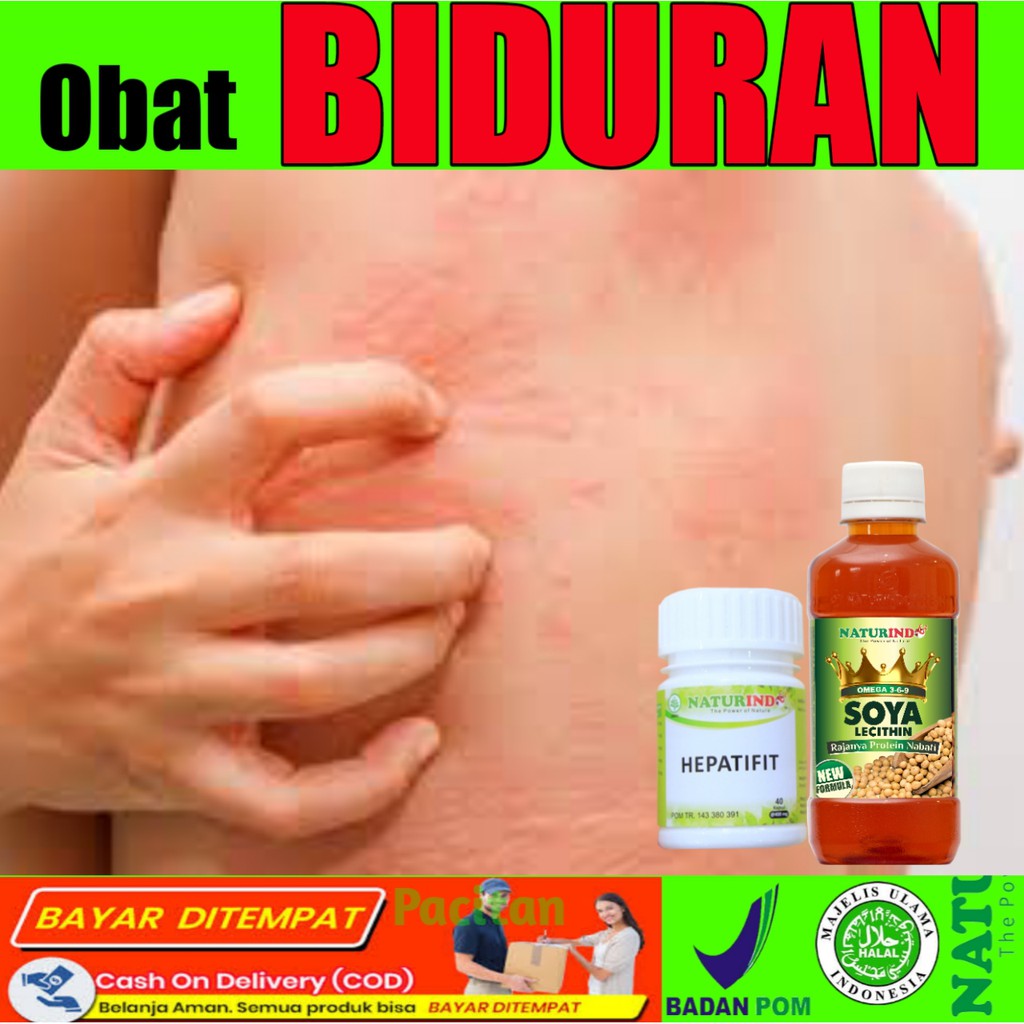 OBAT BIDUR BIDURAN URTIKARIA KALIGATA ALERGI MAKANAN ALERGI DINGIN PALING AMPUH NATURINDO BISA COD