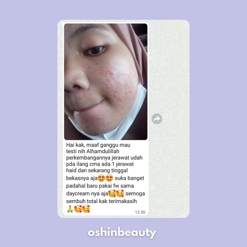 (ECER ACNE) OshinBeauty - Acne Series Oshin Beauty Skincare [Free Gift]-6