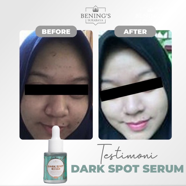 BENING'S SERUM DARK SPOT | MENGATASI FLEK, MELASMA &amp; MENCERAHKAN | FREE GIFT SIAP KIRIM SELURUH INDONESIA