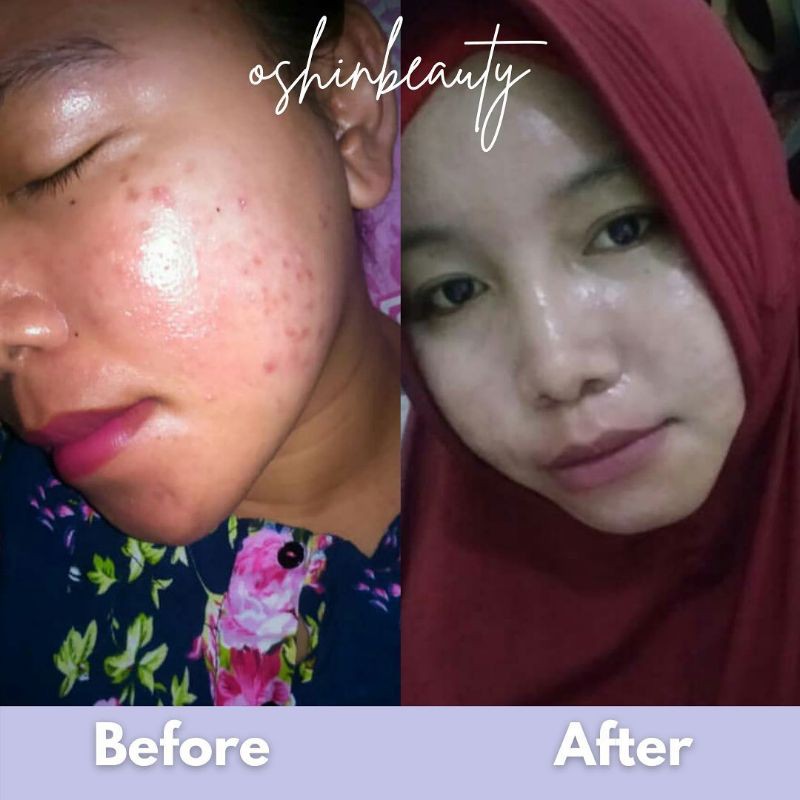 Oshin Beauty | Oshinbeauty | Paket Acne Series | Paket Glow Series | Ecer/Satuan BPOM