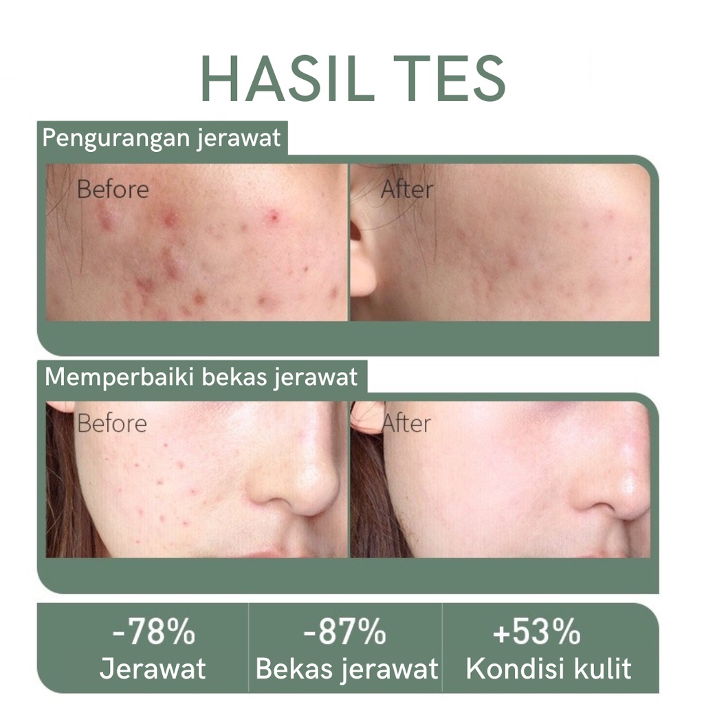 Girlpal Tea Tree Anti Acne Facial Foam Cleanser Fasial Wash Tea Tree Acne Treatment Foam Pembersih Wajah Muka Jerawat Komedo Hidung Dan Berminyak Bpom