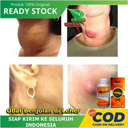 Obat Menghilangkan Benjolan Di leher Kanan,Benjolan Di Leher Kiri,Benjolan Di Leher Belakang,Obat Le