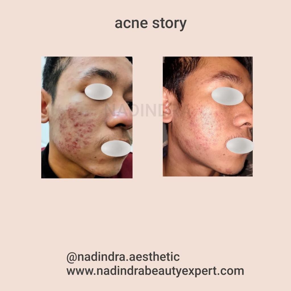 Nadindra Beauty Expert paket Pre Treatment Acne - step 1 / netralisir efek samping skincare keras-4