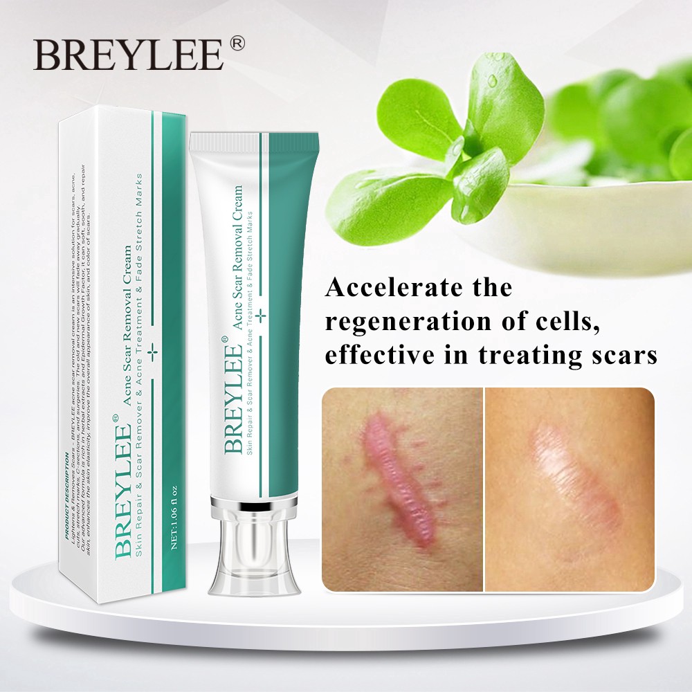 BREYLEE Acne Cream Krim Penghilang Noda Bekas Jerawat, Luka &amp; Stretch Mark (30g)