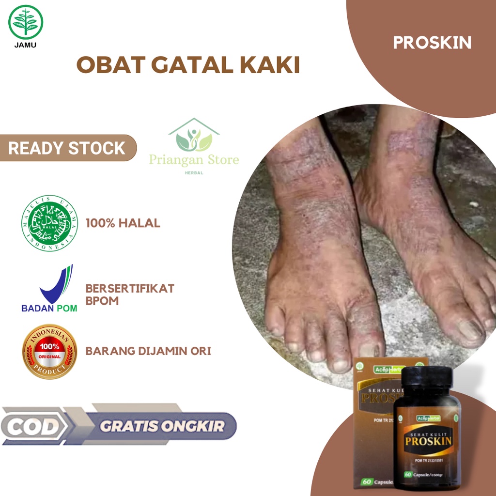 Obat Gatal Kaki, Gatal Budug di Kaki, Obat Gatal Kaki Berair, Obat Gatal Kaki Pecah Pecah, Obat Gata