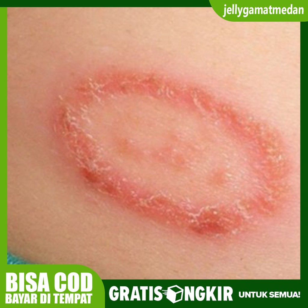 Obat Kurap Terbukti Aman - 100% BERKHASIAT PROPOLIS SM Yogyakarta