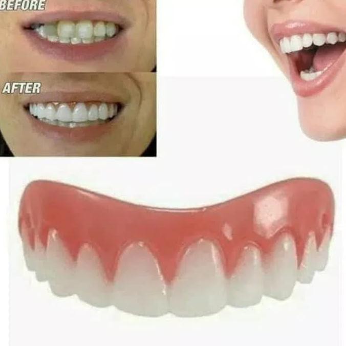 Gigi Palsu Veneer Gigi Ompong Tambal Teeth Estetika Kecantikan Mulut